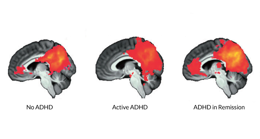 attention deficit hyperactivity disorder brain