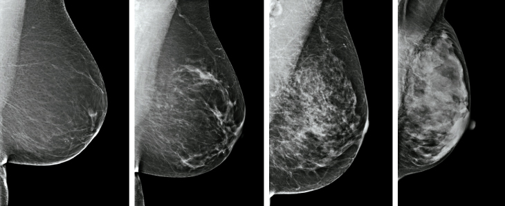 Mammography’s limits becoming clear