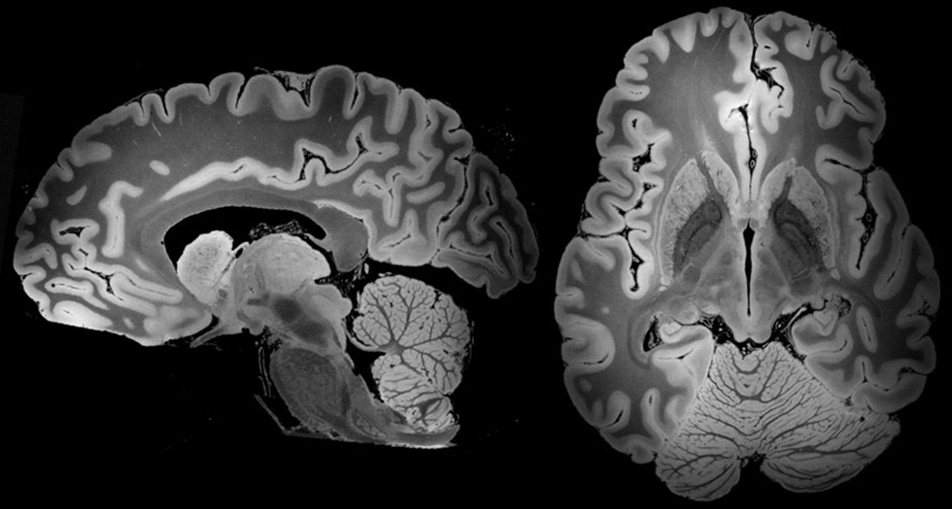 mri brain scan anatomy