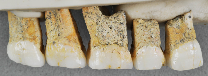 hominid teeth