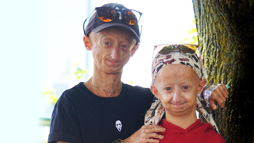 black kids with progeria
