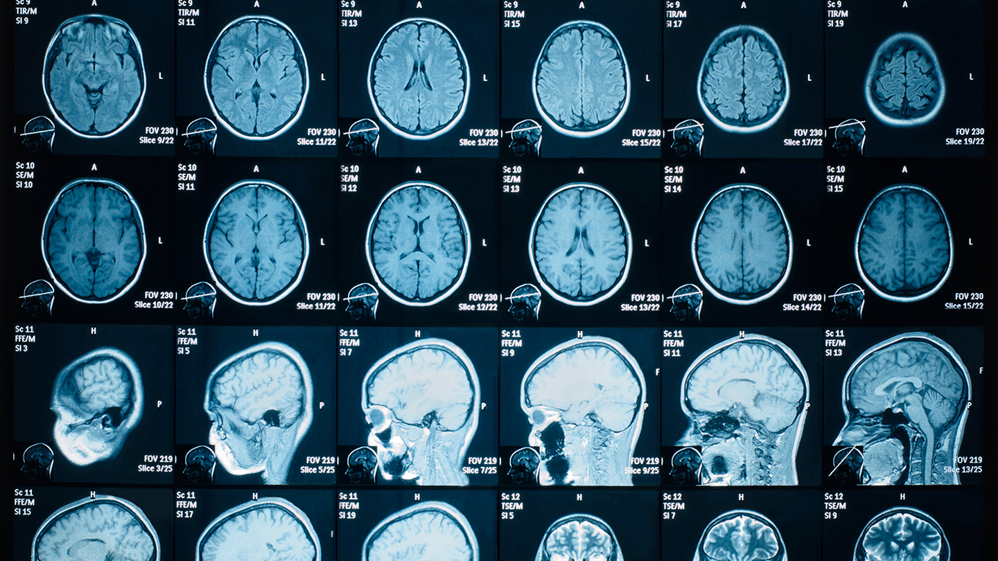 What Do We Mean By COVID 19 Changes Your Brain Science News 