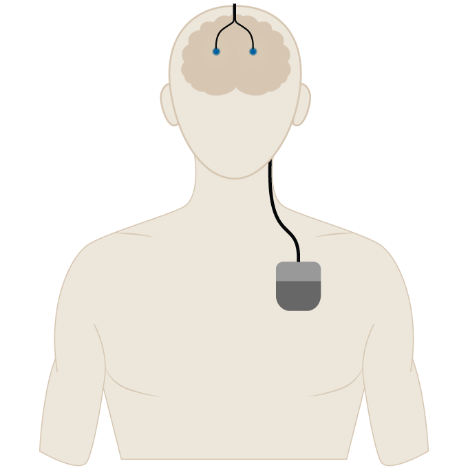 An illustration of the top half of a person with two wires in their brain and a gray box in their chest connected to those wires.