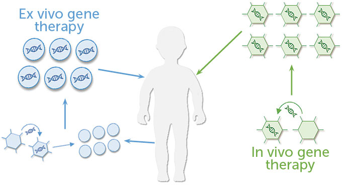 A diagram shows how ex vivo gene therapy works compared to in vivo gene therapy.